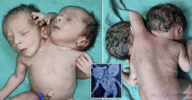 Baby born with two heads