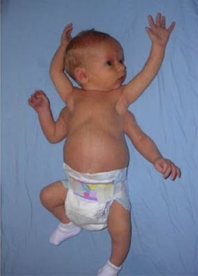 Baby Born With Three Arms. vang